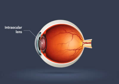 Origins of Eye Treatments: Cataract Surgery - Houston