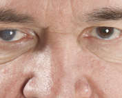 houston-Latest-Innovations-cataract-surgery