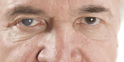 houston-Latest-Innovations-cataract-surgery